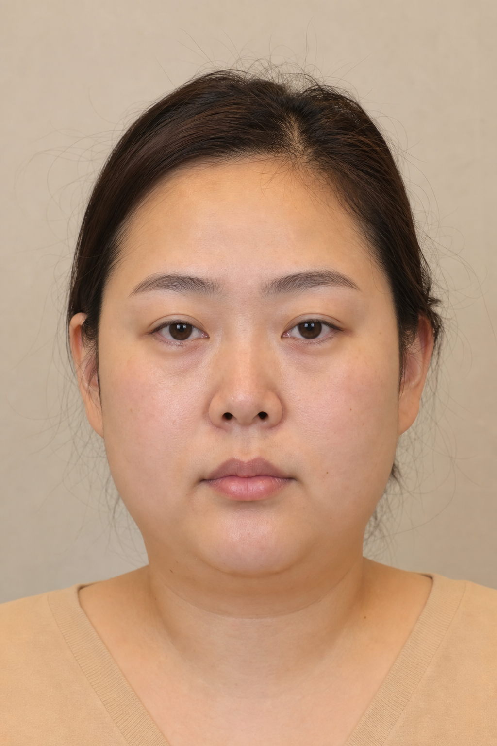 지방분해주사 소개